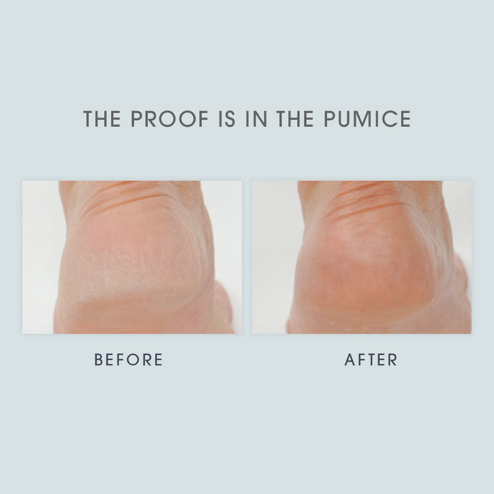 Lavender &amp; Eucalyptus Foot Crème before and after images of a person&#39;s heel. The before image looks dry and rough, the after image looks smooth and soft.